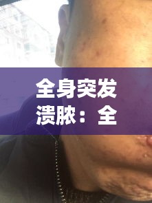 全身突发溃脓：全身皮肤溃烂化脓怎么办 