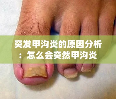 突发甲沟炎的原因分析：怎么会突然甲沟炎 