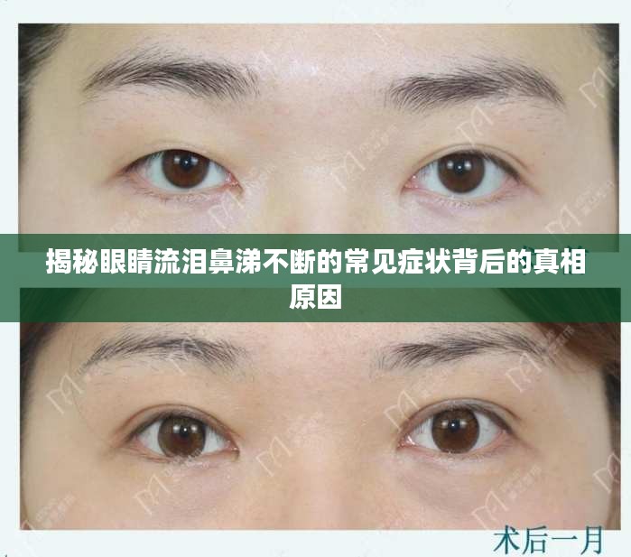 揭秘眼睛流泪鼻涕不断的常见症状背后的真相原因